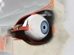 Bionic Eye