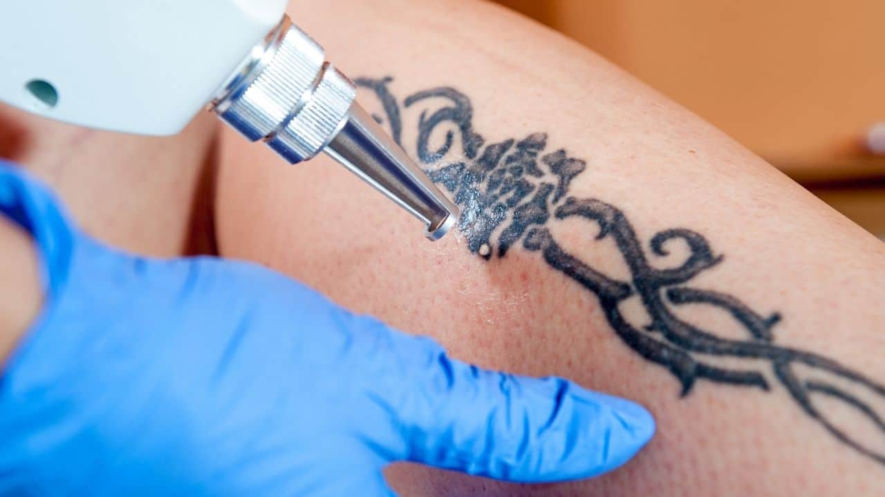 tetoválás eltávolítása lézerrel