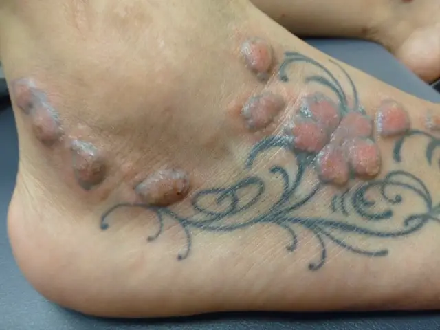 tetoválás allergia lábon